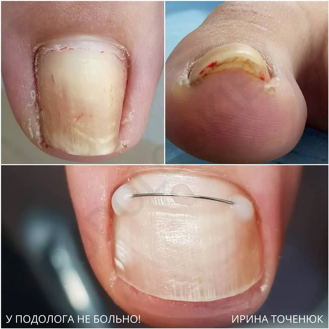 Корекційна система "Титанова нитка"