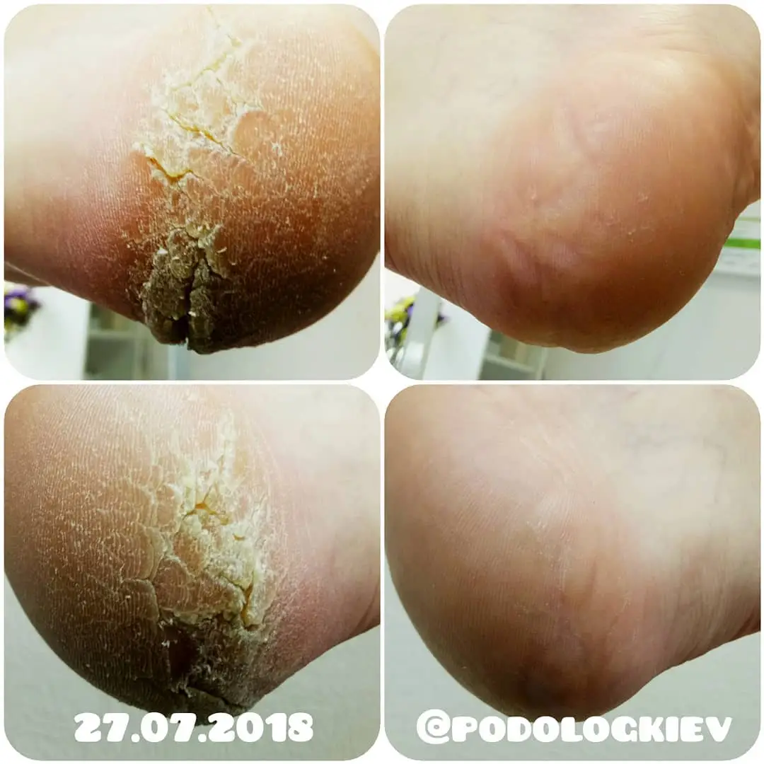Обробка гіперкератозу на п'ятах в Podokom.com