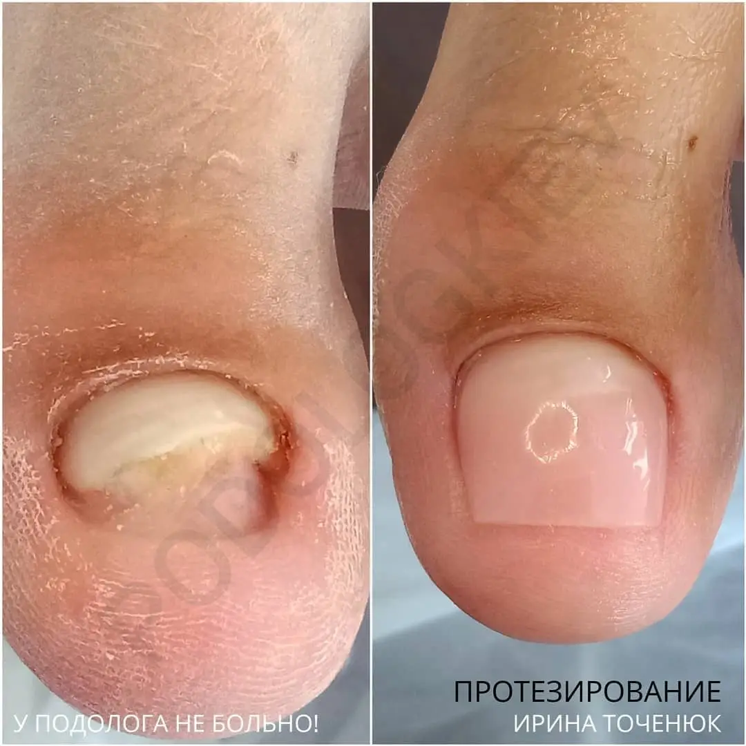 Протезування нігтя