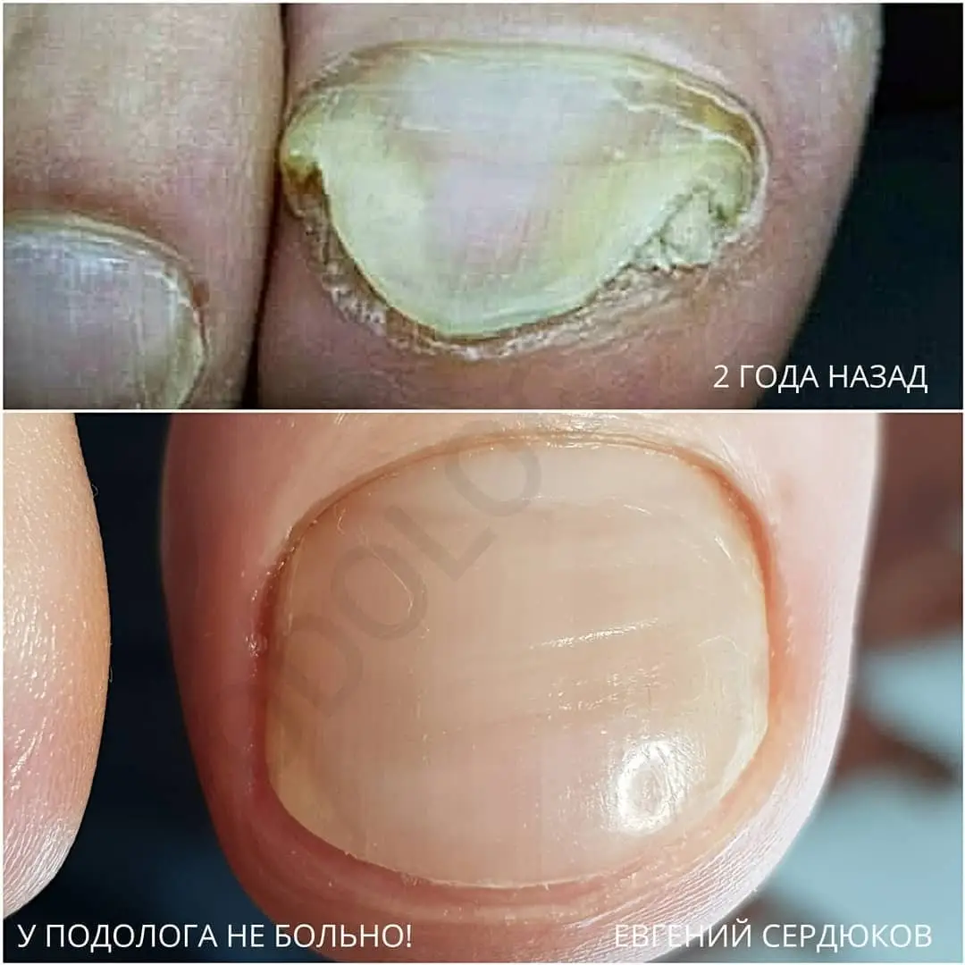 Оніхомікоз (грибок)